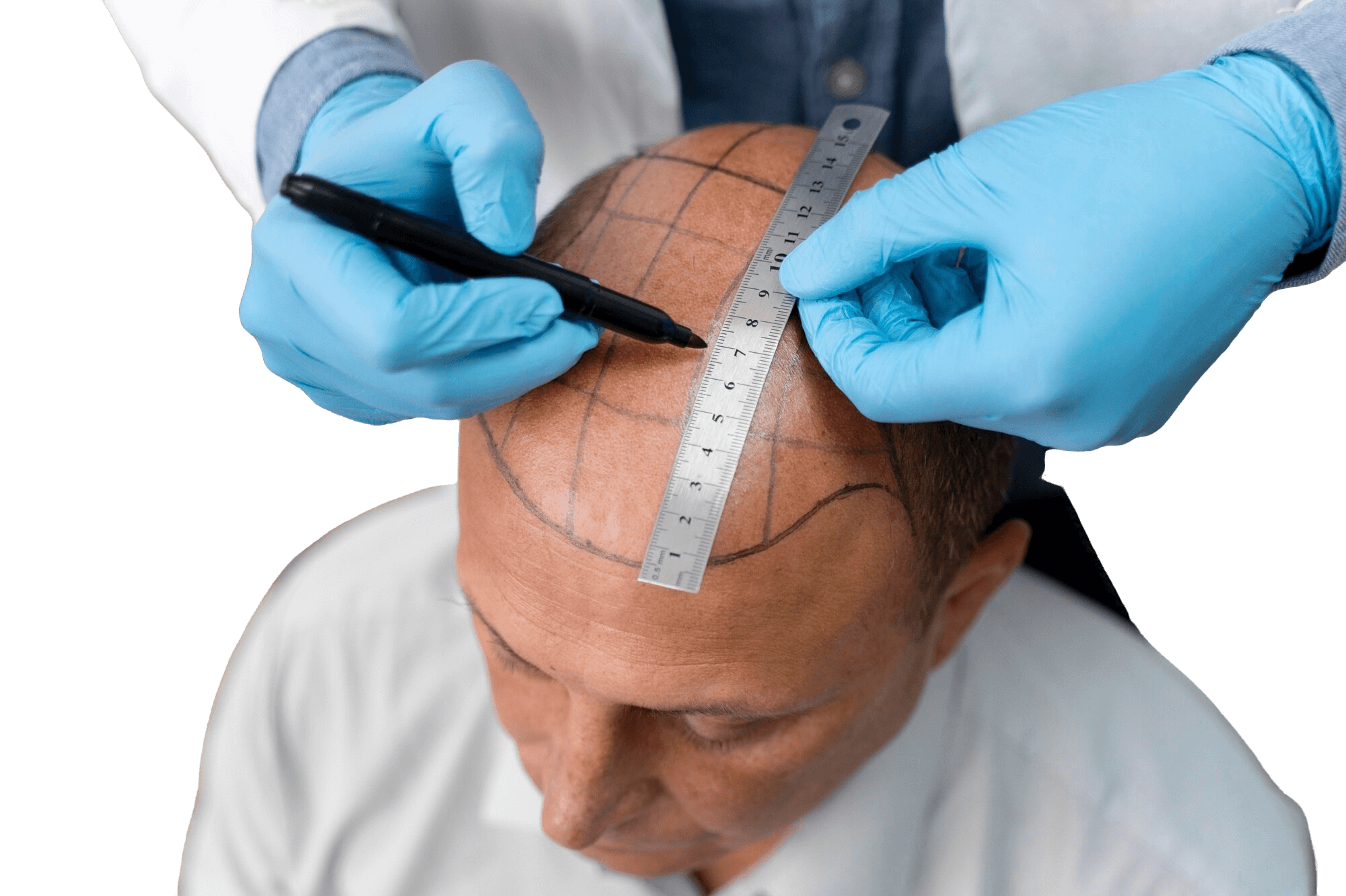 Hair Transplant Dr Itishree Gupta