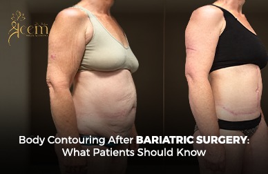 Body Contouring After Bariatric Surgery: What Patients Should Know